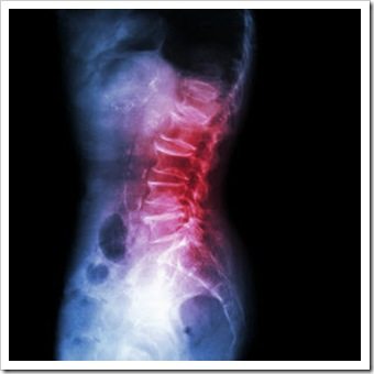Back Pain Pooler GA Arthritis