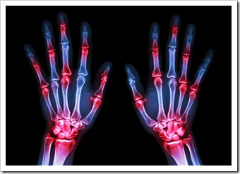 Rheumatoid Arthritis Solutions Pooler GA