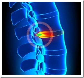 Back Pain Pooler GA Spinal Decompression