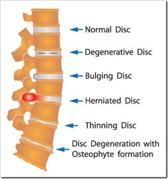 Back Pain Pooler GA Arthritis