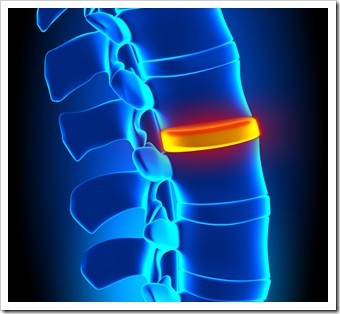 Herniated Disc and Back Pain Pooler GA