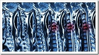 Back Pain Rehab Pooler GA Spinal Surgery